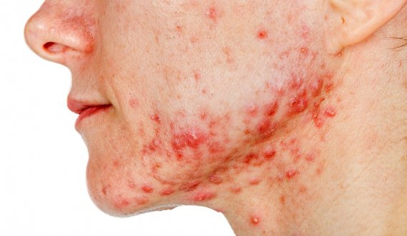 Për të gjithë ata të cilët vuajnë nga aknet, ja ku po iu sjellim disa trajtime efikase të rekomanduara nga dermatologët