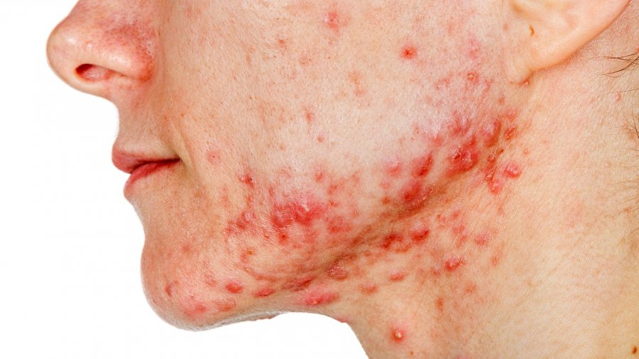 Për të gjithë ata të cilët vuajnë nga aknet, ja ku po iu sjellim disa trajtime efikase të rekomanduara nga dermatologët