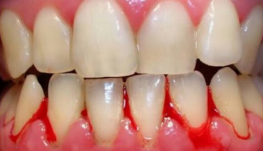 Gjakderdhje te mishrat e dhëmbëve? Keni mungesë të kësaj vitamine