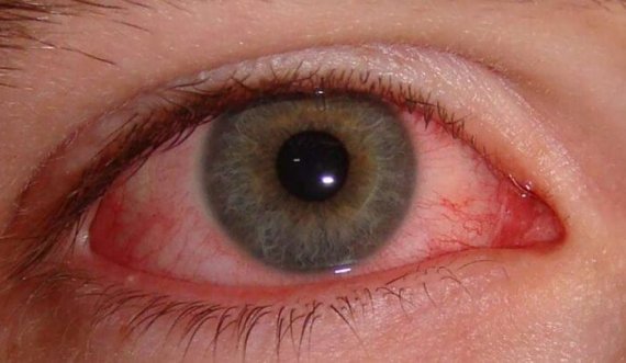 Mjeku shqiptar bën thirrje të keni kujdes nga ‘gripi i syrit’: Këto janë simptomat 