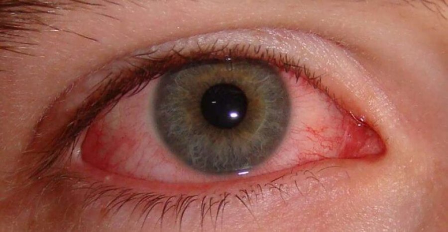 Mjeku shqiptar bën thirrje të keni kujdes nga ‘gripi i syrit’: Këto janë simptomat 