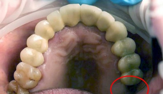Mjekët heqin një dhëmb që po rritej brenda testikujve të 13-vjeçarit