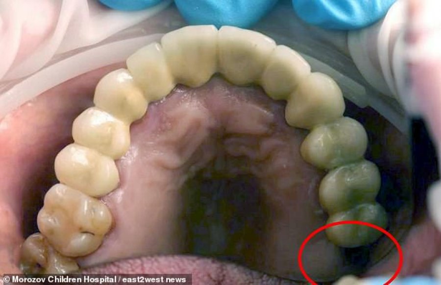 Mjekët heqin një dhëmb që po rritej brenda testikujve të 13-vjeçarit