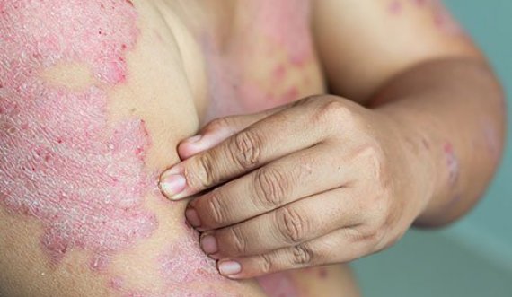 Çka është Psoriasis?