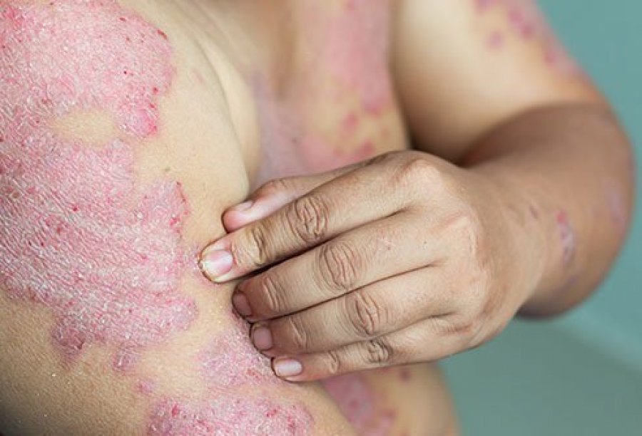 Çka është Psoriasis?