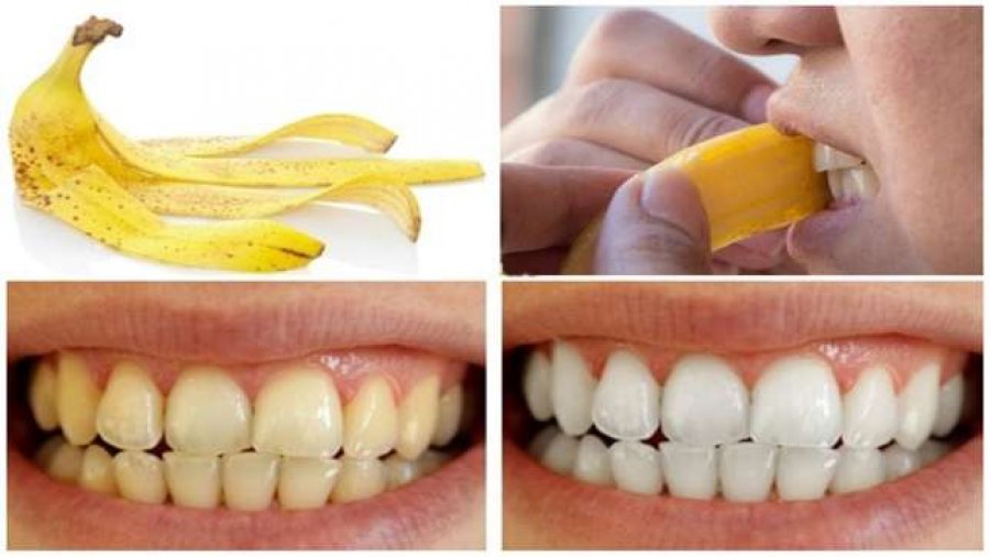 Kjo është metoda shumë efikas si t'i bëni dhëmbët tuaj të bardhë