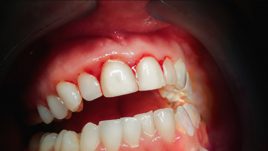 Disa ilaçe shtëpiake që ndihmojnë në shërimin e mishrave të dhëmbëve nga gjakderdhja