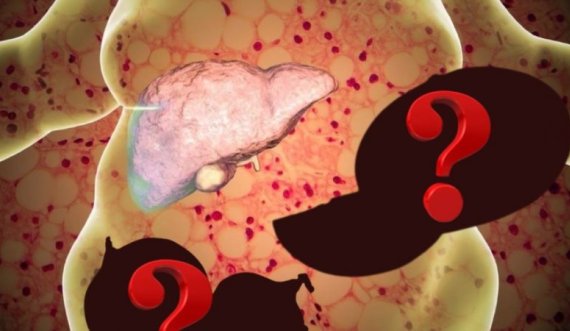 Mjekët zbulojnë më në fund sekretin, 3 ushqimet që janë shpëtimi i mëlçisë së dhjamosur