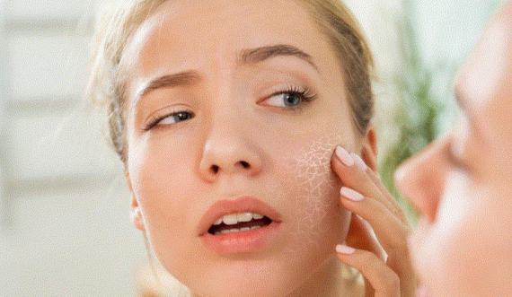 A keni lëkurë të thatë në verë? 