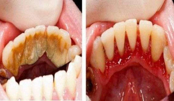 Si t'i hiqni pllakat e formuara në dhëmb dhe në mishin e dhëmbëve në mënyrë krejt natyrale?