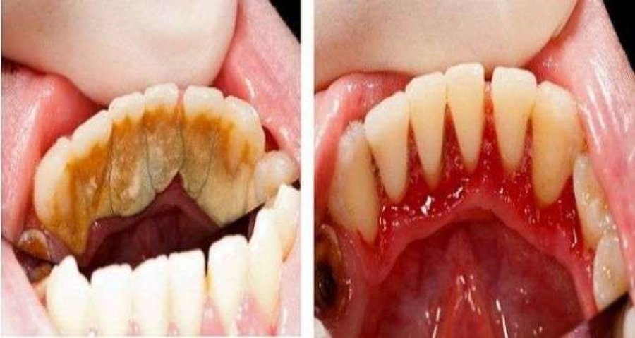 Si t'i hiqni pllakat e formuara në dhëmb dhe në mishin e dhëmbëve në mënyrë krejt natyrale?