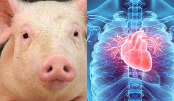 Kryhet transplantimi i dy zemrave të derrit edhe tek dy persona