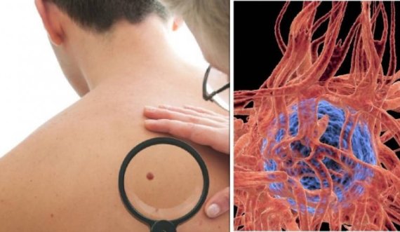 Burrat kanë më shumë gjasa të vdesin nga kanceri i lëkurës sesa gratë