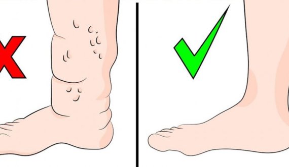 Shenja në këmbë që mund të tregojë se zemra nuk pompon gjak siç duhet