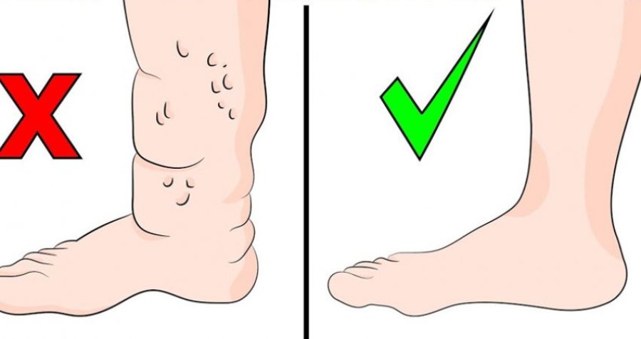 Shenja në këmbë që mund të tregojë se zemra nuk pompon gjak siç duhet
