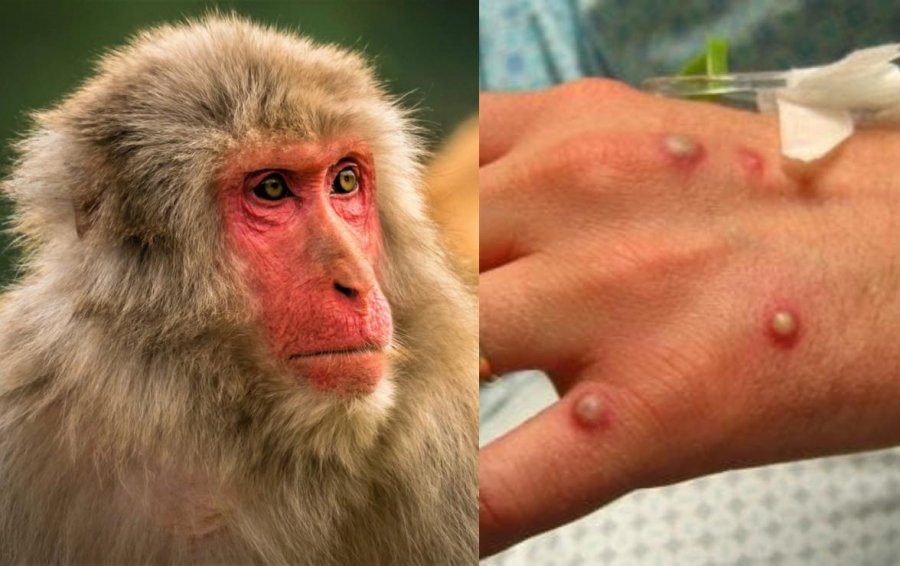OBSH e shpall emergjencë globale shëndetësore linë e majmunit