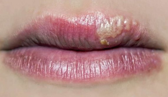 Pse shfaqet herpesi në buzë?