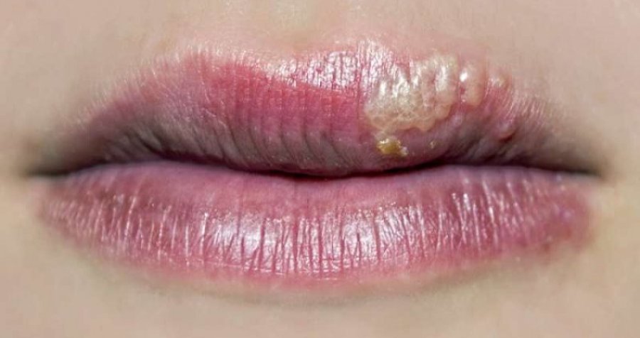 Pse shfaqet herpesi në buzë?