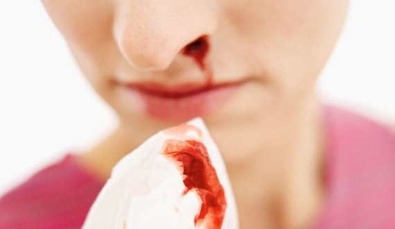 Çfarë e shkakton gjakderdhjen nga hunda