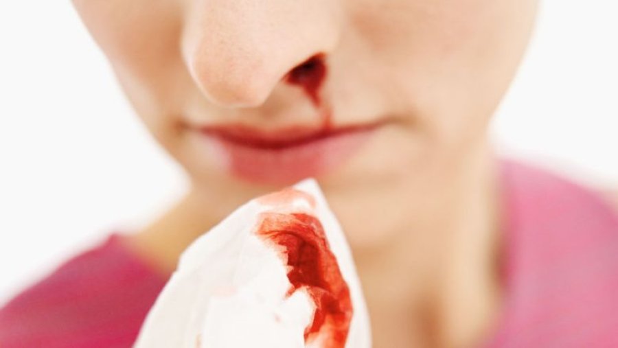 Çfarë e shkakton gjakderdhjen nga hunda