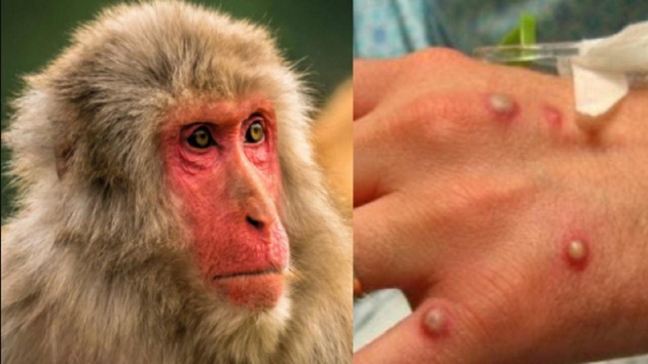 Shënohet viktima e parë nga lia e majmunit në Europë