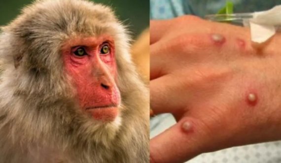 Këto dy shtete konfirmojnë rastet e para me Linë e Majmunëve