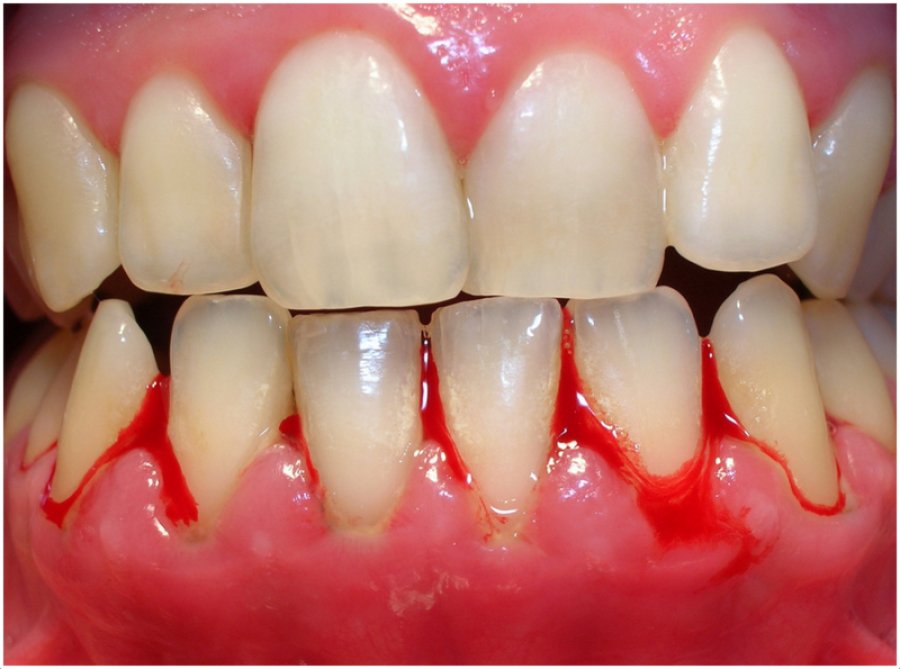 Lidhja midis mishit të dhëmbëve dhe kancerit të vezoreve