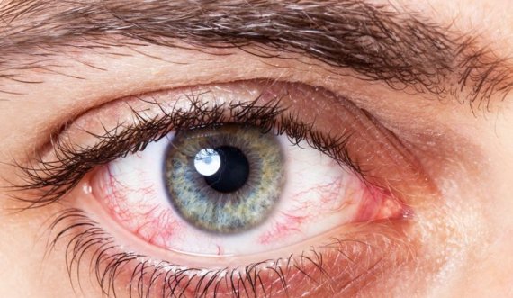 Simptoma e parë e një ataku kardiak shihet te sytë: Nëse e vëreni, kontaktoni urgjentisht mjekun