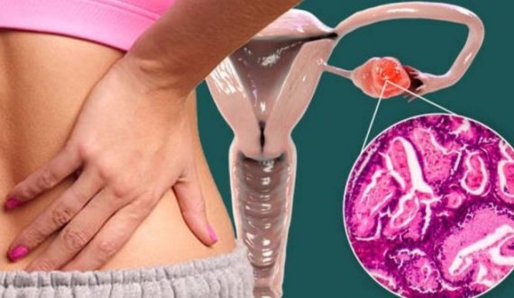 Simptomat e kancerit të vezoreve – Shenja delikate në shpinën tuaj që tregon ‘qelizat e kancerit’