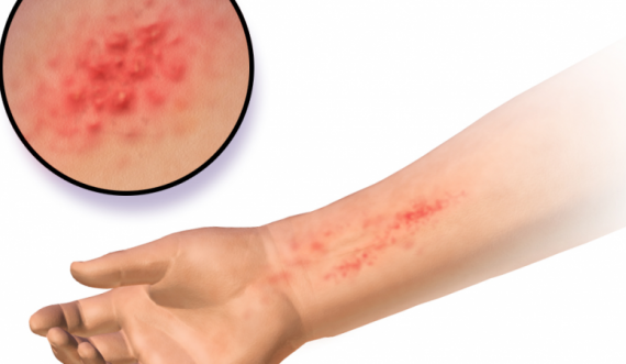 Çka është dermatiti i kontaktit?