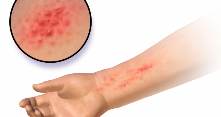 Çka është dermatiti i kontaktit?