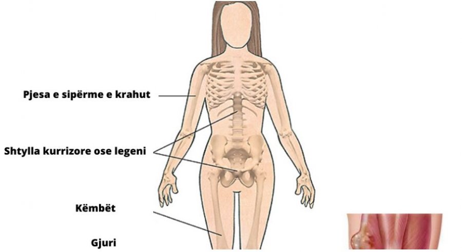 Kanceri i kockave, çfarë është “sarkoma” dhe si trajtohet?