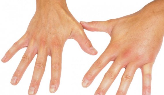 Çfarë tregojnë duart e ftohta për shëndetin