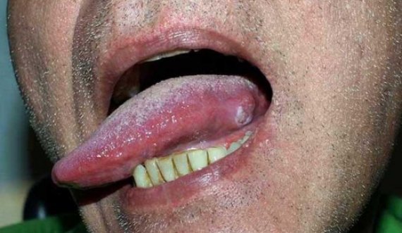 Kanceri në gojë: Tri shenjat e hershme që asnjëherë nuk duhet t’i injoroni