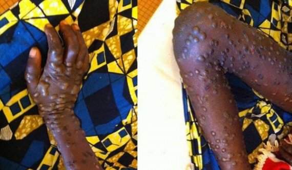 Eksperti: Lija e majmunit mund të jetë përhapur përmes marrëdhënieve