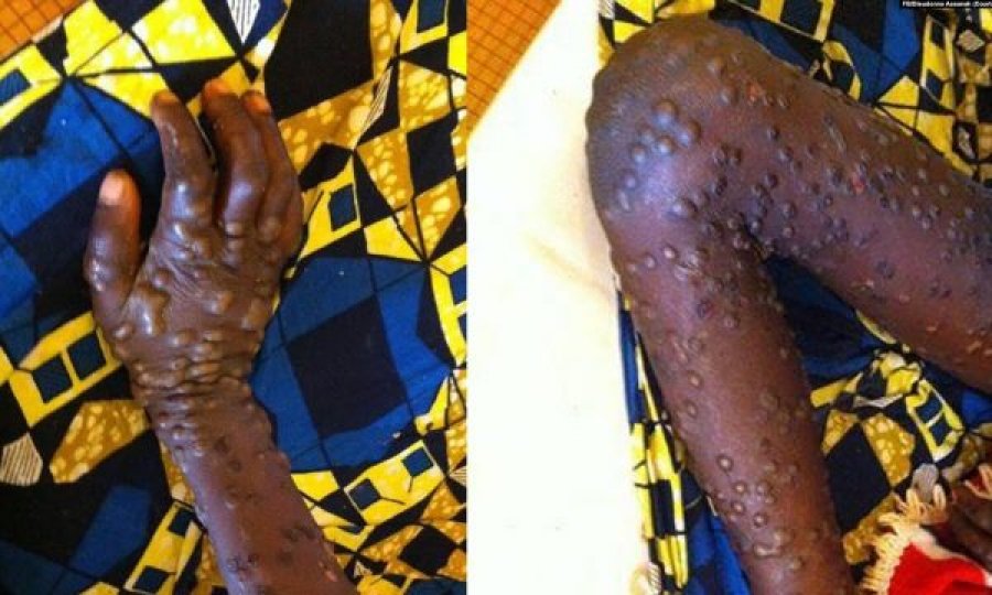 Eksperti: Lija e majmunit mund të jetë përhapur përmes marrëdhënieve