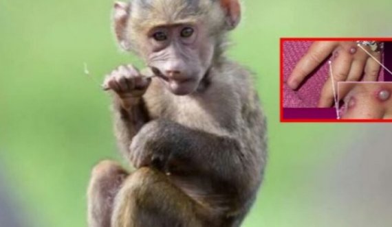 Lija e majmunit: Si transmetohet tek njerëzit, çfarë shenjash shfaqen dhe sa zgjasin simptomat