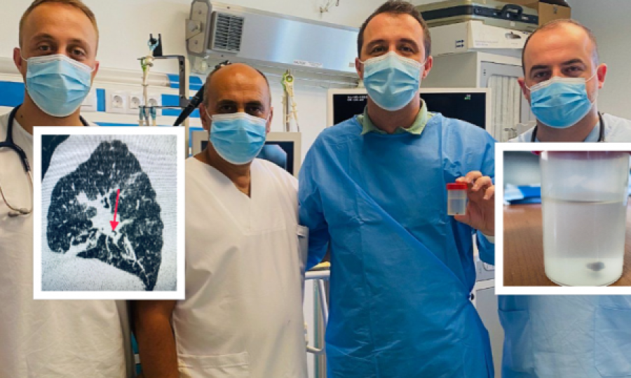 Mjekët në Pulmologji ia largojnë 84 vjeçarit një trup të huaj, i shkaktoi pneumoni të rëndë