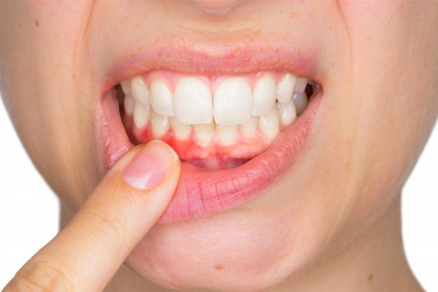 Mënyrat se si të shpëtojmë nga dhimbja e dhëmbit