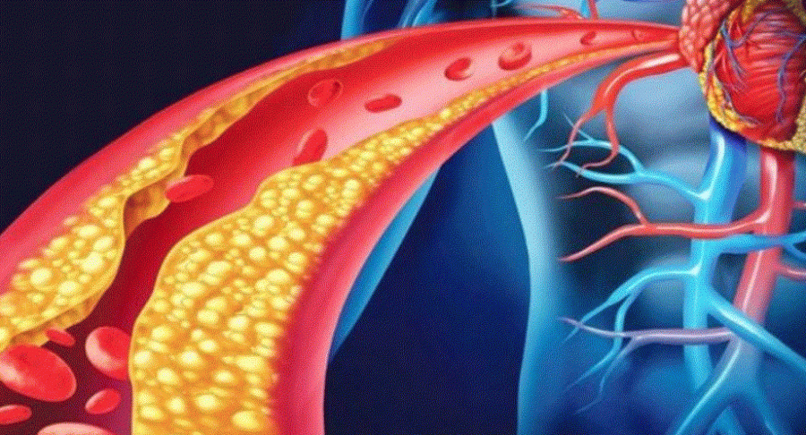 Kjo është simptoma kryesore që tregon se keni kolesterol të lartë