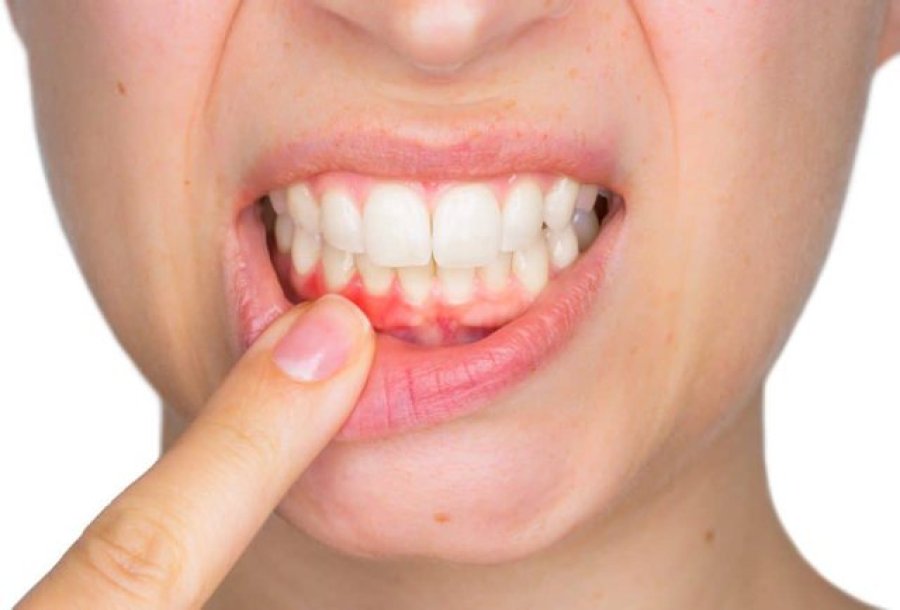 Ja sëmundja që shkakton rënien e dhëmbëve