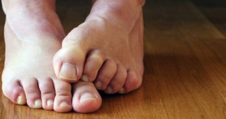 ​Simptomat e diabetit: Si këmbët tuaja mund të tregojnë sheqer të lartë në gjak