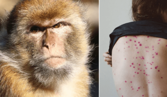 A do të shndërrohet lija e majmunëve në një pandemi?