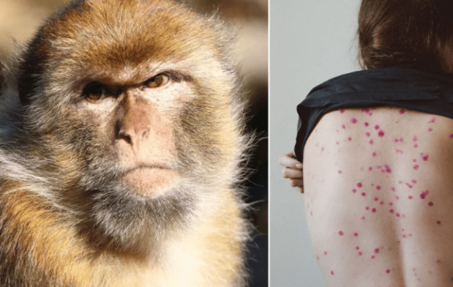 A do të shndërrohet lija e majmunëve në një pandemi?