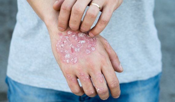 Psoriaza është një sëmundje inflamatore kronike 
