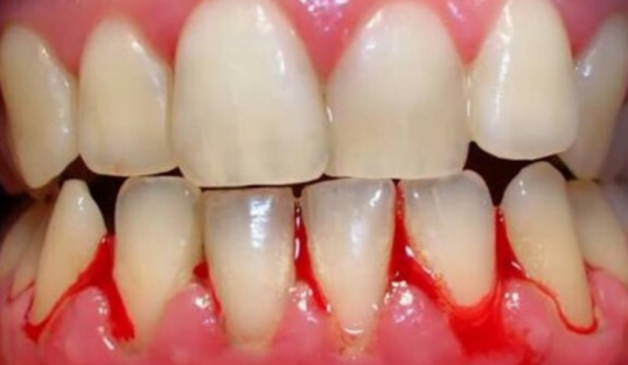 Mos e injoroni rrjedhjen e gjakut nga mishrat e dhëmbëve