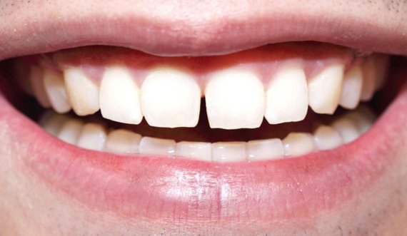 Si shkaktohet tejndjeshmëria e dhëmbëve?