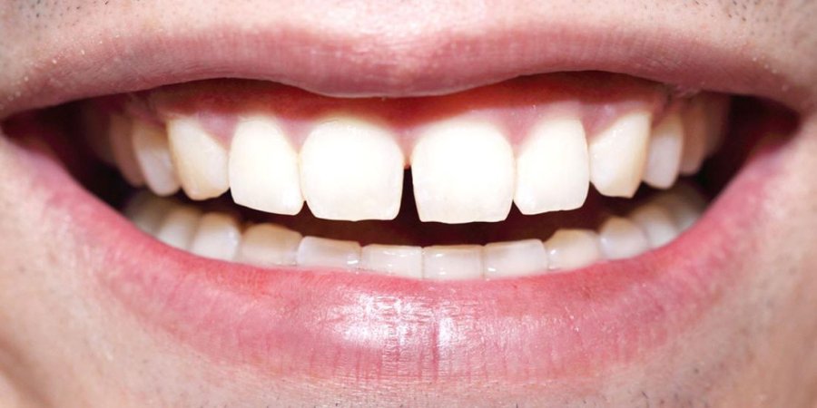 Si shkaktohet tejndjeshmëria e dhëmbëve?