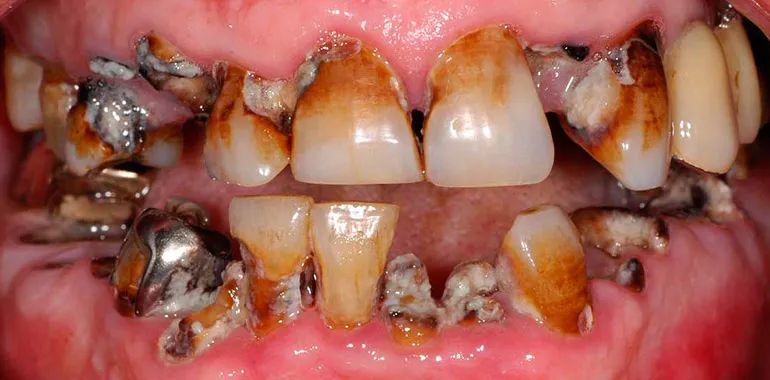 Këto janë sëmundjet e rënda që i shkaktojnë dhëmbët e prishur