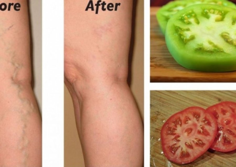 Ilaçi shtëpiak, që shëron venat e zgjeruara, përdorni domate të gjelbërta dhe të kuqe